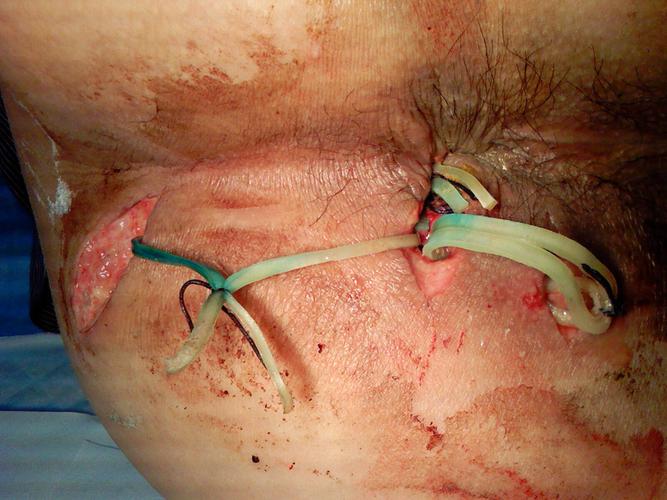 肛瘘手术图片