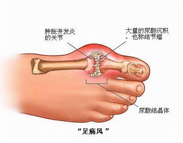 大脚趾拇痛是怎么回事的相关图片